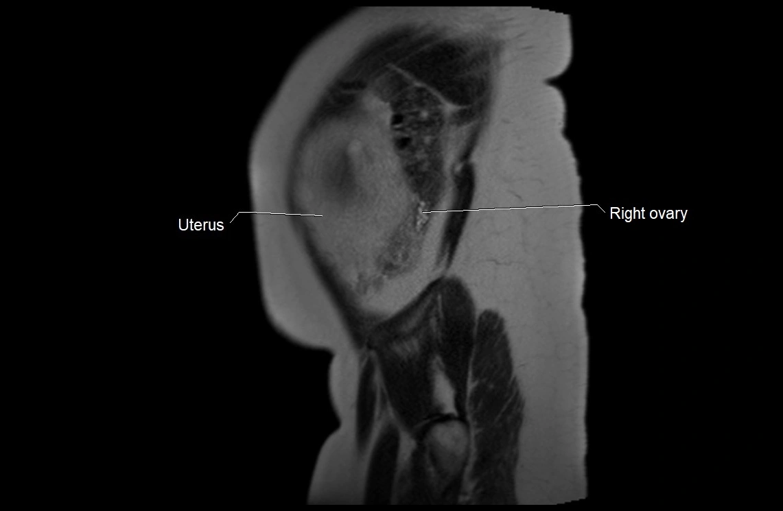 MRI fetal anatomy sagittal image 3.webp